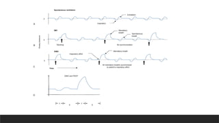 0
0
0
SIMV and PEEP
All mandatory breaths synchronized
to patient’s inspiratory effort
Stacking
Airway
pressure
No synchronization
Mandatory breath
Spontaneous
breath
Mandatory
breath
Spontaneous ventilation
IMV
SIMV
Exhalation
Inspiration
Inspiratory effort
Time
E E
A
B
C
D
 