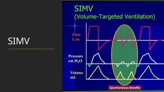 SIMV
 