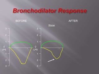 2
1
1
2
3
3
V
LPS
.
BEFORE AFTER
Worse
2
1
1
2
3
3
V
LPS
.
 