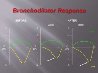 2
1
1
2
3
3
V
LPS
.
VT
INSP
EXH
BEFORE AFTER
Worse Better
2
1
1
2
3
3
V
LPS
.
2
1
1
2
3
3
V
LPS
.
 
