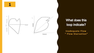 302928272625242322212019181716151413121110987654321
Inadequate Flow
“ Flow Starvation”
 