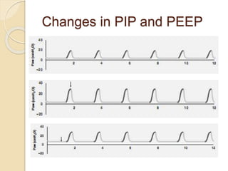 Changes in PIP and PEEP
 