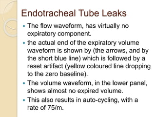 Endotracheal Tube Leaks
 The flow waveform, has virtually no
expiratory component.
 the actual end of the expiratory volume
waveform is shown by (the arrows, and by
the short blue line) which is followed by a
reset artifact (yellow coloured line dropping
to the zero baseline).
 The volume waveform, in the lower panel,
shows almost no expired volume.
 This also results in auto-cycling, with a
rate of 75/m.
 