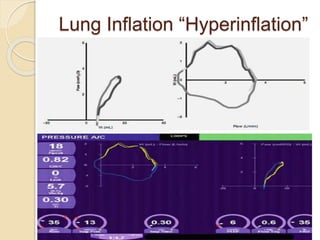 Lung Inflation “Hyperinflation”
 