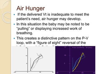 Air Hunger
 If the delivered Vt is inadequate to meet the
patient’s need, air hunger may develop.
 In this situation the baby may be noted to be
“pulling” or displaying increased work of
breathing.
 This creates a distinctive pattern on the P-V
loop, with a “figure of eight” reversal of the
inflation and deflation limbs at the top of the
loop.
 