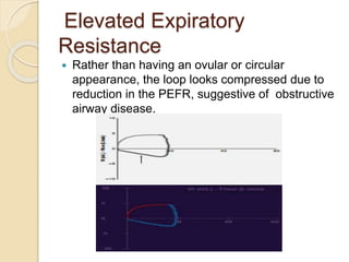 Elevated Expiratory
Resistance
 Rather than having an ovular or circular
appearance, the loop looks compressed due to
reduction in the PEFR, suggestive of obstructive
airway disease.
 