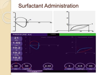 Surfactant Administration
 