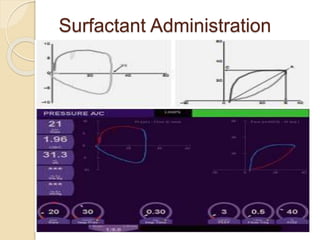 Surfactant Administration
 