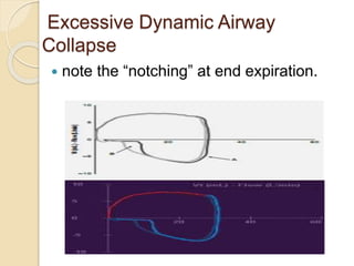 Excessive Dynamic Airway
Collapse
 note the “notching” at end expiration.
 