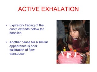 ACTIVE EXHALATION
• Expiratory tracing of the
curve extends below the
baseline
• Another cause for a similar
appearance is poor
calibration of flow
transducer
 