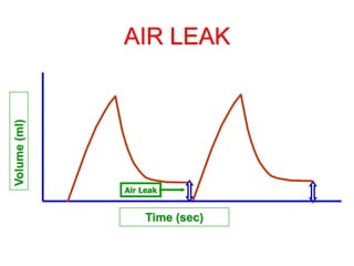 AIR LEAK
Volume
(ml)
Time (sec)
Air Leak
 