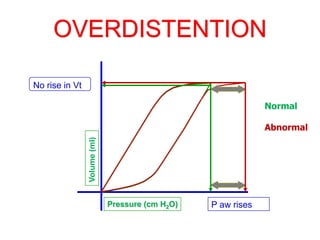 OVERDISTENTION
Volume
(ml)
Pressure (cm H2O)
Normal
Abnormal
P aw rises
No rise in Vt
 