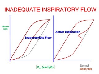 INADEQUATE INSPIRATORY FLOW
Paw (cm H2O)
Volume
(ml)
Normal
Abnormal
Active Inspiration
Inappropriate Flow
 