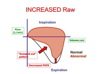 INCREASED Raw
Inspiration
Expiration
Volume (ml)
Flow
(L/min)
Decreased PEFR
Normal
Abnormal
“Scooped out”
pattern
 