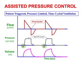 ASSISTED PRESSURE CONTROL
Pressure
Flow
Volume
(L/min)
(cm H2O)
(ml)
Set PC level
Time (sec)
Time-Cycled
Patient Triggered, Pressure Limited, Time Cycled Ventilation
 