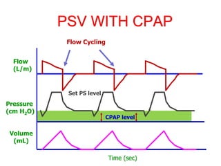 PSV WITH CPAP
Set PS level
CPAP level
Time (sec)
Flow
(L/m)
Pressure
(cm H2O)
Volume
(mL)
Flow Cycling
 
