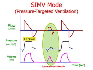 Pressure
Flow
Volume
(L/min)
(cm H2O)
(ml)
Set PC level
Time (sec)
SIMV Mode
(Pressure-Targeted Ventilation)
Spontaneous Breath
 