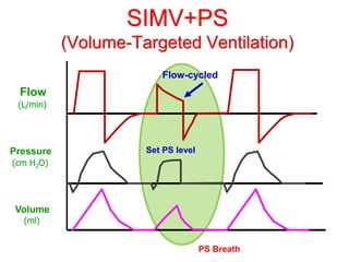 SIMV+PS
(Volume-Targeted Ventilation)
Flow
Pressure
Volume
(L/min)
(cm H2O)
(ml)
Set PS level
PS Breath
Flow-cycled
 