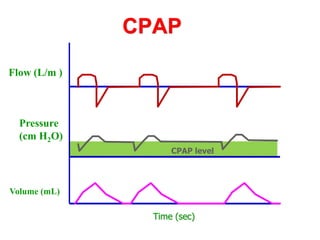 CPAP
Time (sec)
CPAP level
Flow (L/m )
Pressure
(cm H2O)
Volume (mL)
 