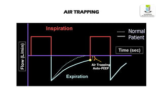 AIR TRAPPING
 