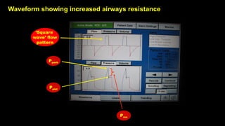 Waveform showing increased airways resistance
Ppeak
Pplat
Pres
‘Square
wave’ flow
pattern
 