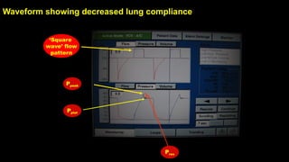 Waveform showing decreased lung compliance
Ppeak
Pplat
Pres
‘Square
wave’ flow
pattern
 