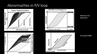 Abnormalities in P/V loop
Alveolar over
distention
Increased WOB
 