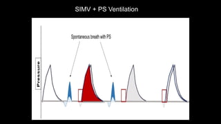 SIMV + PS Ventilation
 