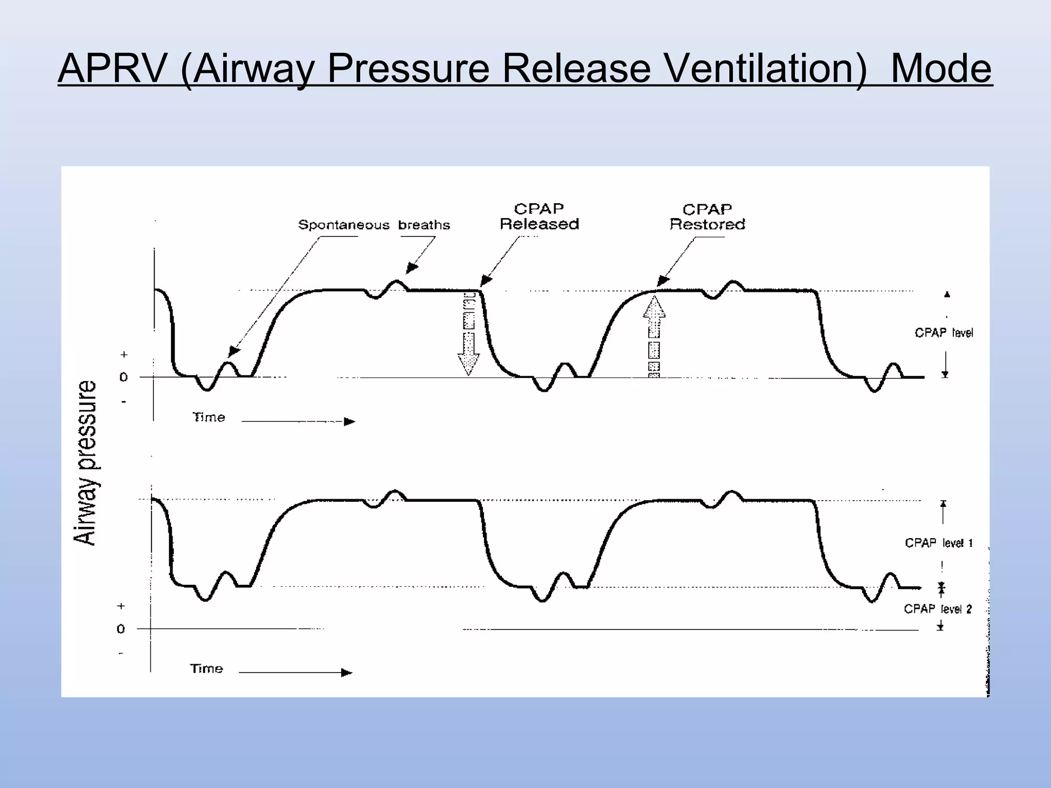 APRV (Airway Pressure Release Ventilation) Mode
 