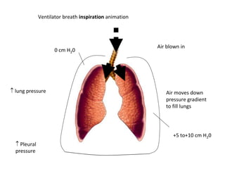 Ventilator breath inspiration animation
Air blown in
 lung pressure Air moves down
pressure gradient
to fill lungs
 Pleural
pressure
0 cm H20
+5 to+10 cm H20
 