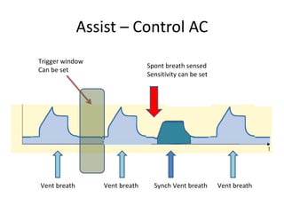 Assist – Control AC
Trigger window
Can be set
Vent breath Vent breath Synch Vent breath Vent breath
Spont breath sensed
Sensitivity can be set
 