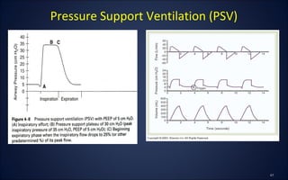 Pressure Support Ventilation (PSV)
 