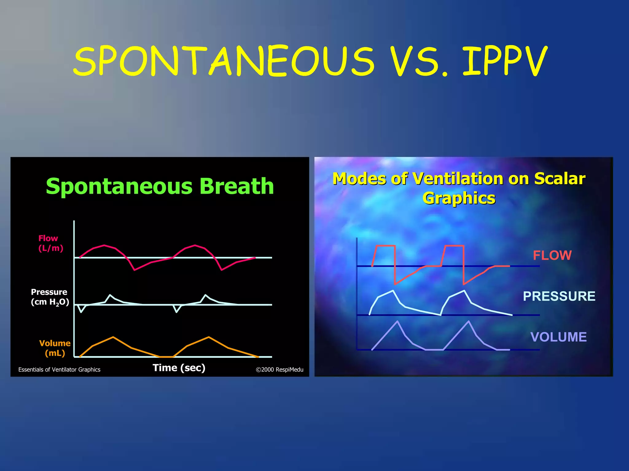 ventilator waveforms Dr Sanjay Chugh.pptx