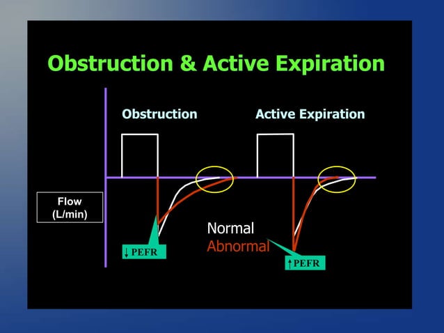 ventilator waveforms Dr Sanjay Chugh.pptx | Lung and Respiratory Health ...