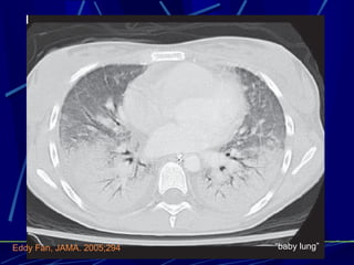 “ baby lung” Eddy Fan, JAMA. 2005;294 