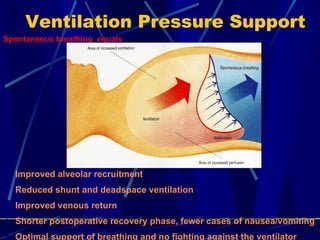 Ventilation  Pressure Support Improved alveolar recruitment Reduced shunt and deadspace ventilation Improved venous r eturn Shorter p ostoperative  recovery phase ,  fewer cases of nausea/vomiting Optimal support of breathing and no fighting against the v entilator Spontan eous breathing  equals   