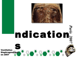 I Ventilation Diaphragmatique en 2007 Paris  2007 ndications 