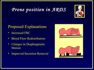 Prone position in ARDS
Proposed Explanations
• Increased FRC
• Blood Flow Redistribution
• Changes in Diaphragmatic
Motion
• Improved Secretion Removal
 