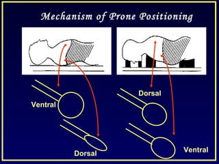 Ventral
Dorsal
Dorsal
Ventral
Mechanism of Prone Positioning
 