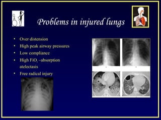 Problems in injured lungs
• Over distension
• High peak airway pressures
• Low compliance
• High FiO2 –absorption
atelectasis
• Free radical injury
 