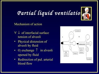 Partial liquid ventilation
Mechanism of action
∀ ↓ of interfacial surface
tension of alveoli
• Physical distension of
alveoli by fluid
• O2 exchange ↑ in alveoli
opened by fluid
• Redirection of pul. arterial
blood flow
 