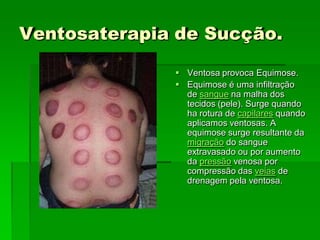 Ventosaterapia de Sucção.
 Ventosa provoca Equimose.
 Equimose é uma infiltração
de sangue na malha dos
tecidos (pele). Surge quando
ha rotura de capilares quando
aplicamos ventosas. A
equimose surge resultante da
migração do sangue
extravasado ou por aumento
da pressão venosa por
compressão das veias de
drenagem pela ventosa.
 