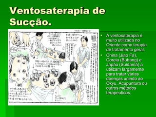 Ventosaterapia de
Sucção.
 A ventosaterapia é
muito utilizada no
Oriente como terapia
de tratamento geral.
 China (Jiao Fa),
Coreia (Buhang) e
Japão (Suidamá) a
utilizam largamente
para tratar várias
doenças unindo ao
Okyu, Acupuntura ou
outros métodos
terapeuticos.
 