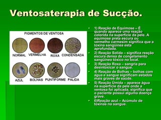 Ventosaterapia de Sucção.
 1) Reação de Equimose – É
quando aparece uma reação
colorida na superfície da pele. A
equimose preta escura ou
vermelho carmesim significa que a
toxina sangüínea esta
aprofundada.
 2) Reação Solida – significa reação
escura densa de congelamento
sangüíneo tóxico no local.
 3) Reação Roxa – sangria para
desintoxicar o sangue.
 4) Reação de Bolhas – bolhas com
água e sangue significam estados
mais graves de saúde.
 5) Reação Úmida – aparece água
na superfície da pele onde a
ventosa foi aplicada, significa que
o paciente possui alguma doença
grave.
 6)Reação azul – Acúmulo de
toxinas no sangue.
 