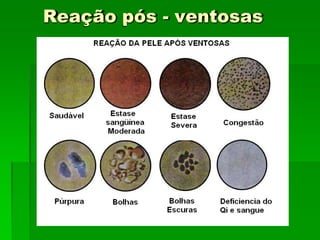 Reação pós - ventosas
 