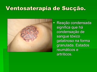 Ventosaterapia de Sucção.
 Reação condensada
significa que há
condensação de
sangue tóxico
gelatinoso na forma
granulada. Estados
reumáticos e
artríticos.
 