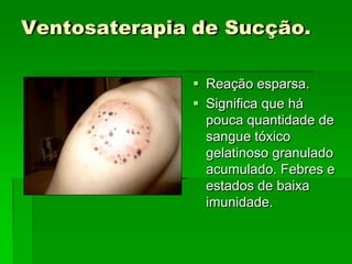 Ventosaterapia de Sucção.
 Reação esparsa.
 Significa que há
pouca quantidade de
sangue tóxico
gelatinoso granulado
acumulado. Febres e
estados de baixa
imunidade.
 