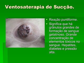 Ventosaterapia de Sucção.
 Reação puntiforme.
 Significa que há
grânulos grandes de
formação de sangue
gelatinoso. Grande
concentração de
elementos tóxicos no
sangue. Hepatites,
diabetes e pressão
alta.
 