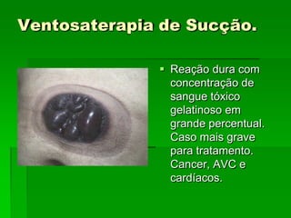 Ventosaterapia de Sucção.
 Reação dura com
concentração de
sangue tóxico
gelatinoso em
grande percentual.
Caso mais grave
para tratamento.
Cancer, AVC e
cardíacos.
 
