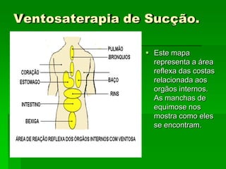 Ventosaterapia de Sucção.
 Este mapa
representa a área
reflexa das costas
relacionada aos
orgãos internos.
As manchas de
equimose nos
mostra como eles
se encontram.
 